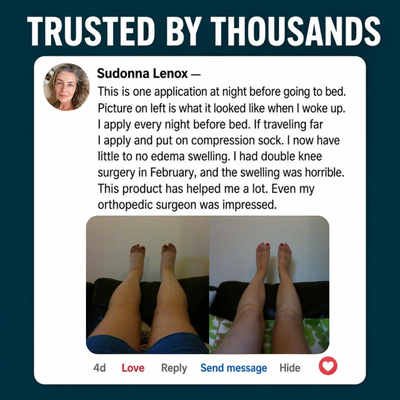 SwellBalm - The Miracle Balm For Leg Edema & Swelling